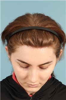 Rhinoplasty After Photo by Jay Xue, MD; Grapevine, TX - Case 50935
