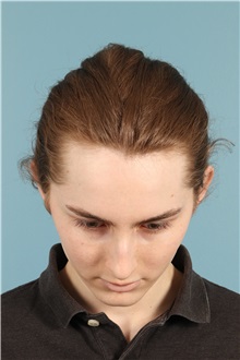 Rhinoplasty Before Photo by Jay Xue, MD; Grapevine, TX - Case 50935