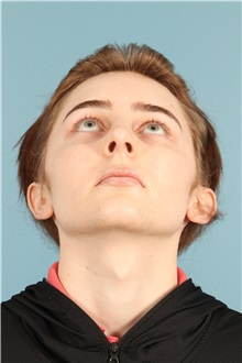 Rhinoplasty After Photo by Jay Xue, MD; Grapevine, TX - Case 50935