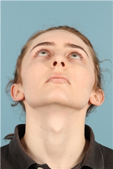 Rhinoplasty Before Photo by Jay Xue, MD; Grapevine, TX - Case 50935