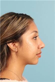 Rhinoplasty After Photo by Jay Xue, MD; Grapevine, TX - Case 50938