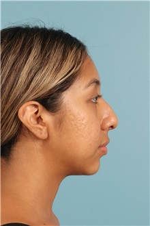 Rhinoplasty Before Photo by Jay Xue, MD; Grapevine, TX - Case 50938