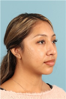 Rhinoplasty After Photo by Jay Xue, MD; Grapevine, TX - Case 50938