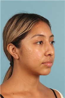 Rhinoplasty Before Photo by Jay Xue, MD; Grapevine, TX - Case 50938