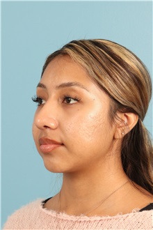 Rhinoplasty After Photo by Jay Xue, MD; Grapevine, TX - Case 50938
