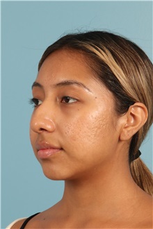Rhinoplasty Before Photo by Jay Xue, MD; Grapevine, TX - Case 50938