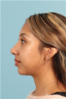 Rhinoplasty After Photo by Jay Xue, MD; Grapevine, TX - Case 50938