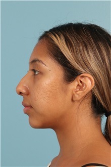Rhinoplasty Before Photo by Jay Xue, MD; Grapevine, TX - Case 50938