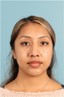 Rhinoplasty After Photo by Jay Xue, MD; Grapevine, TX - Case 50938