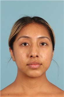 Rhinoplasty Before Photo by Jay Xue, MD; Grapevine, TX - Case 50938