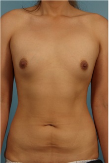 Breast Augmentation Before Photo by Jay Xue, MD; Grapevine, TX - Case 50940