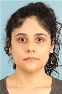 Rhinoplasty After Photo by Jay Xue, MD; Grapevine, TX - Case 51079