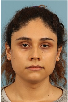 Rhinoplasty Before Photo by Jay Xue, MD; Grapevine, TX - Case 51079