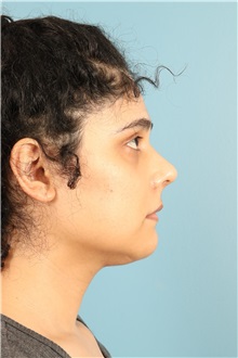 Rhinoplasty After Photo by Jay Xue, MD; Grapevine, TX - Case 51079