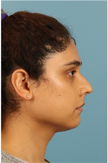 Rhinoplasty Before Photo by Jay Xue, MD; Grapevine, TX - Case 51079