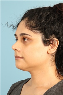 Rhinoplasty After Photo by Jay Xue, MD; Grapevine, TX - Case 51079