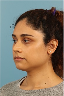 Rhinoplasty Before Photo by Jay Xue, MD; Grapevine, TX - Case 51079