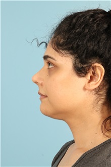 Rhinoplasty After Photo by Jay Xue, MD; Grapevine, TX - Case 51079