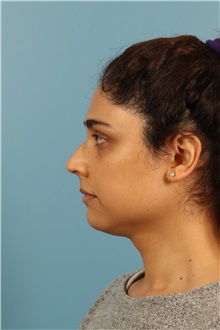 Rhinoplasty Before Photo by Jay Xue, MD; Grapevine, TX - Case 51079