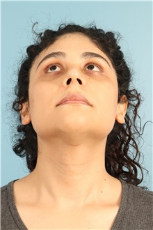 Rhinoplasty After Photo by Jay Xue, MD; Grapevine, TX - Case 51079