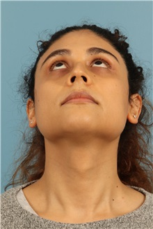 Rhinoplasty Before Photo by Jay Xue, MD; Grapevine, TX - Case 51079