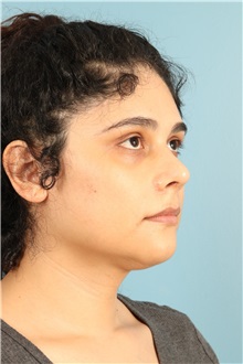Rhinoplasty After Photo by Jay Xue, MD; Grapevine, TX - Case 51079
