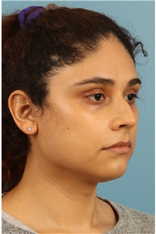 Rhinoplasty Before Photo by Jay Xue, MD; Grapevine, TX - Case 51079