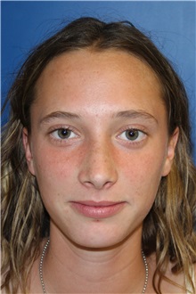 Rhinoplasty After Photo by Jay Xue, MD; Grapevine, TX - Case 51080