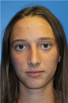 Rhinoplasty Before Photo by Jay Xue, MD; Grapevine, TX - Case 51080