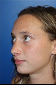 Rhinoplasty After Photo by Jay Xue, MD; Grapevine, TX - Case 51080