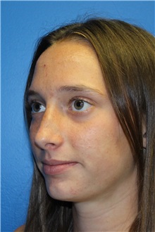 Rhinoplasty Before Photo by Jay Xue, MD; Grapevine, TX - Case 51080