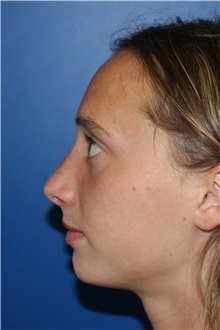 Rhinoplasty After Photo by Jay Xue, MD; Grapevine, TX - Case 51080