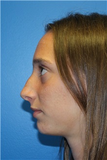 Rhinoplasty Before Photo by Jay Xue, MD; Grapevine, TX - Case 51080