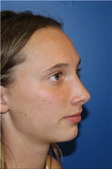 Rhinoplasty After Photo by Jay Xue, MD; Grapevine, TX - Case 51080