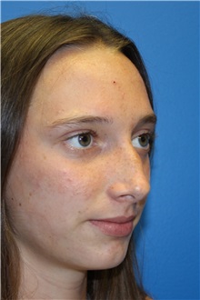 Rhinoplasty Before Photo by Jay Xue, MD; Grapevine, TX - Case 51080