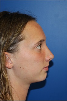 Rhinoplasty After Photo by Jay Xue, MD; Grapevine, TX - Case 51080