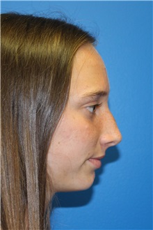 Rhinoplasty Before Photo by Jay Xue, MD; Grapevine, TX - Case 51080