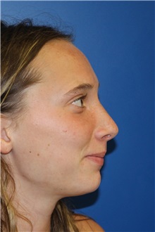 Rhinoplasty After Photo by Jay Xue, MD; Grapevine, TX - Case 51080