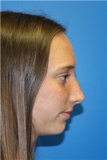 Rhinoplasty Before Photo by Jay Xue, MD; Grapevine, TX - Case 51080
