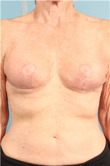 Breast Implant Removal After Photo by Jay Xue, MD; Grapevine, TX - Case 51277