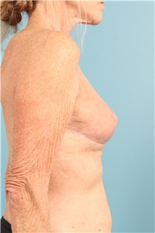 Breast Implant Removal After Photo by Jay Xue, MD; Grapevine, TX - Case 51277