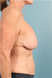 Breast Implant Removal Before Photo by Jay Xue, MD; Grapevine, TX - Case 51277