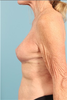 Breast Implant Removal After Photo by Jay Xue, MD; Grapevine, TX - Case 51277