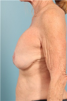 Breast Implant Removal Before Photo by Jay Xue, MD; Grapevine, TX - Case 51277