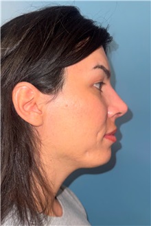 Rhinoplasty After Photo by Jay Xue, MD; Grapevine, TX - Case 51276