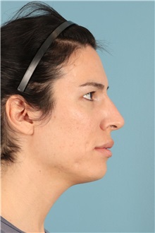 Rhinoplasty Before Photo by Jay Xue, MD; Grapevine, TX - Case 51276