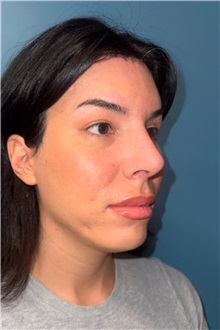 Rhinoplasty After Photo by Jay Xue, MD; Grapevine, TX - Case 51276