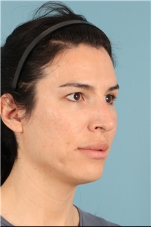 Rhinoplasty Before Photo by Jay Xue, MD; Grapevine, TX - Case 51276