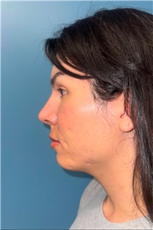Rhinoplasty After Photo by Jay Xue, MD; Grapevine, TX - Case 51276