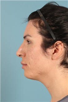 Rhinoplasty Before Photo by Jay Xue, MD; Grapevine, TX - Case 51276